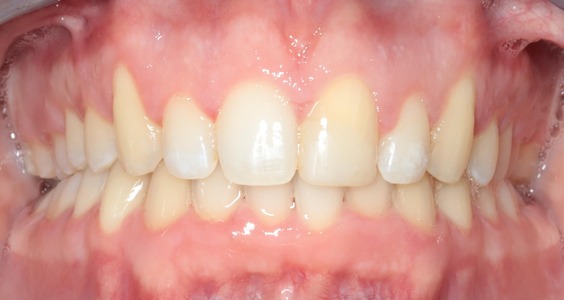 After Teeth